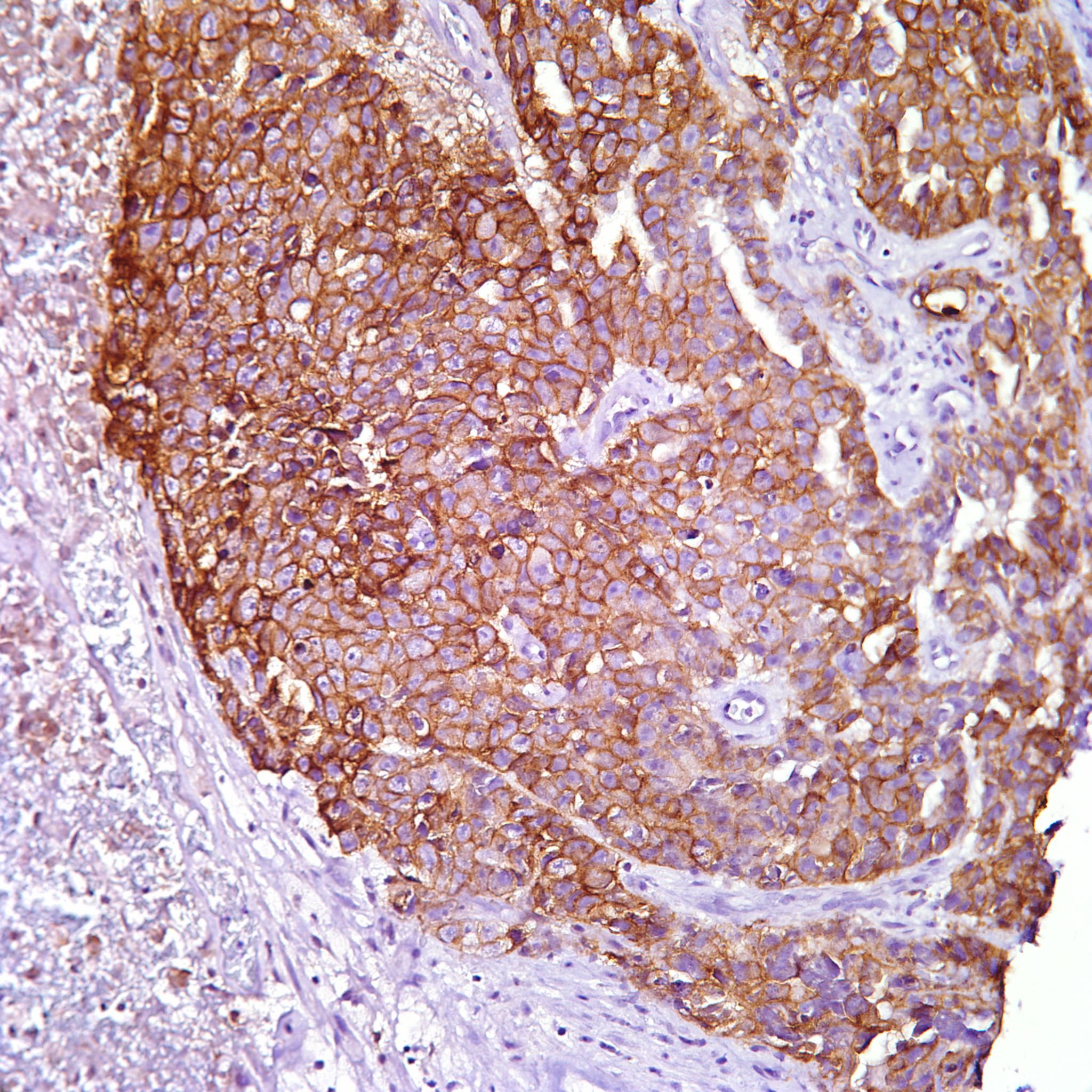 image-cd30-embryonal-carcinoma-jpg-pathology-resident-wiki